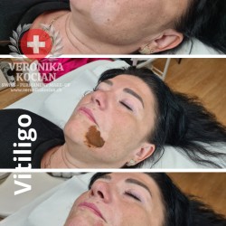 Profesionelle Medizinisches Vitiligo-Tattoo veronika kocian